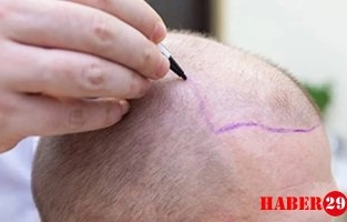 Fue Saç Ekimi Nedir? Başarı Oranları